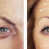 Buy Botox for Under Eye Wrinkles Online