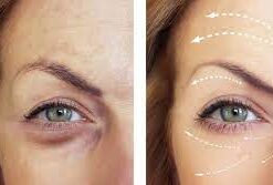 Buy Botox for Under Eye Wrinkles Online